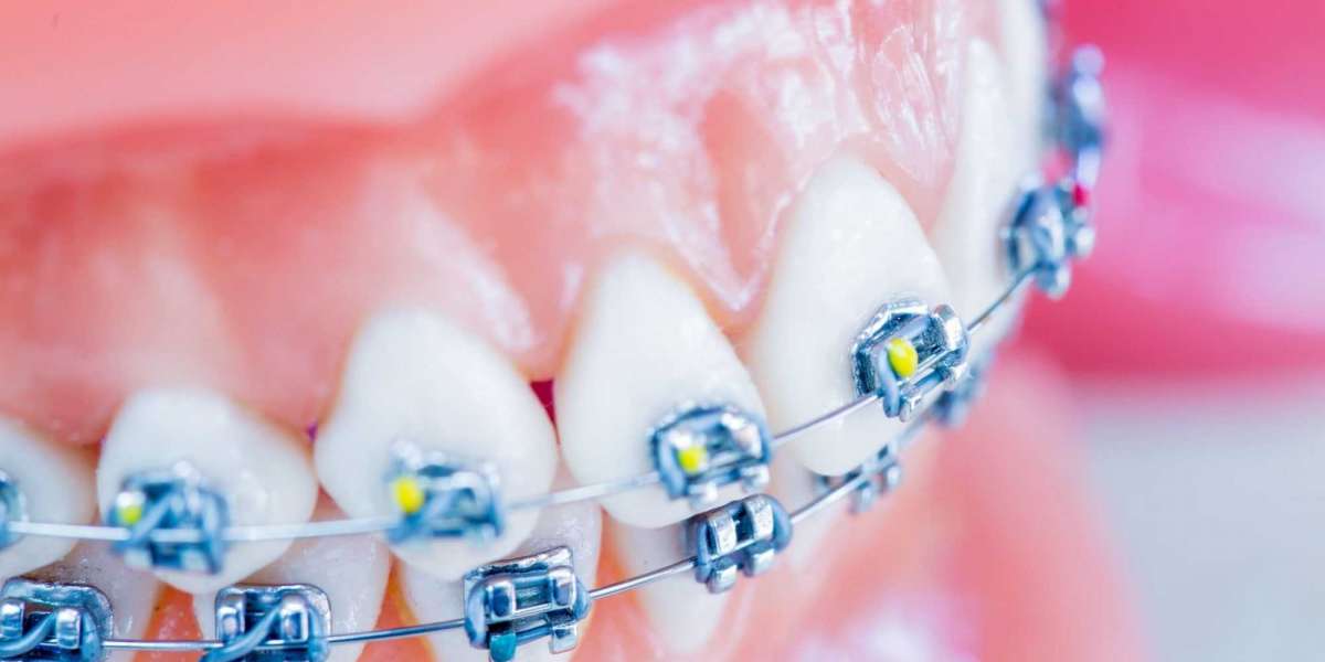 Diş Teli Tedavisinde Dikkat Edilmesi Gerekenler? Yeni Diş Teli Taktıranlar?