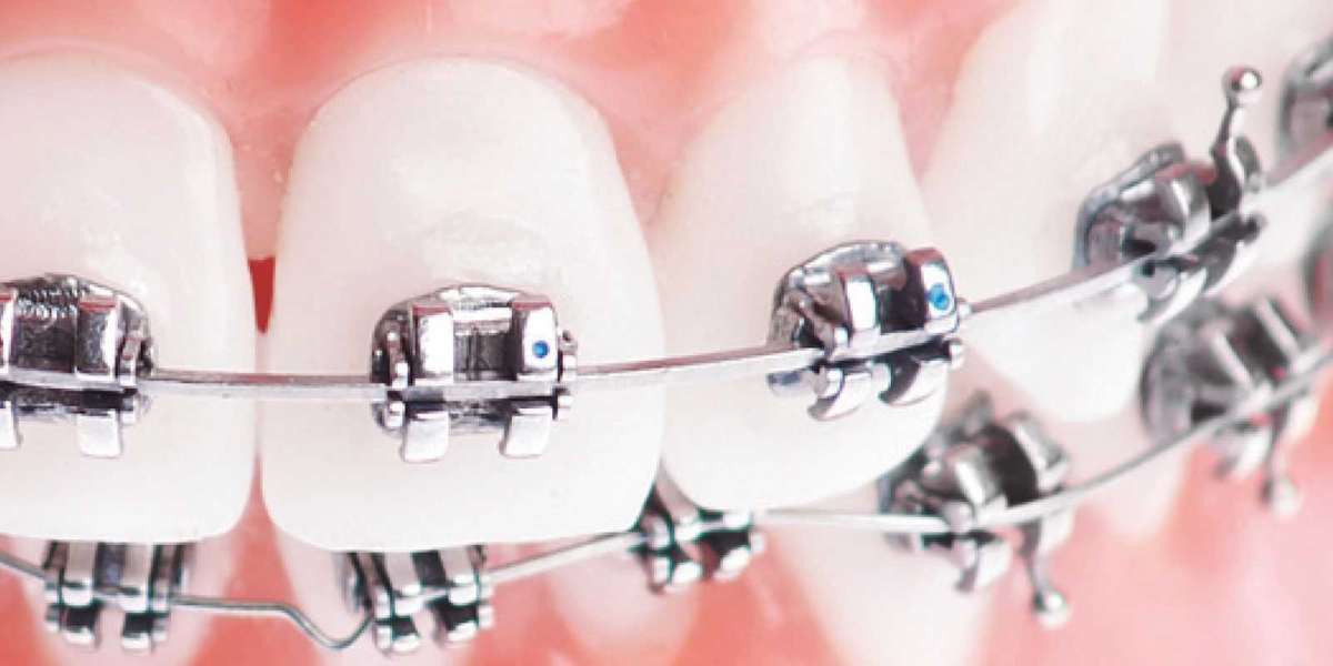Ortodonti Tedavisi Nasıl Yapılır? Çene Yapısı Bozukluğu?