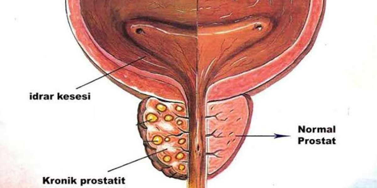 Prostat Nasıl Anlaşılır? Prostat Nasıl Geçer? Prostat Belirtileri?